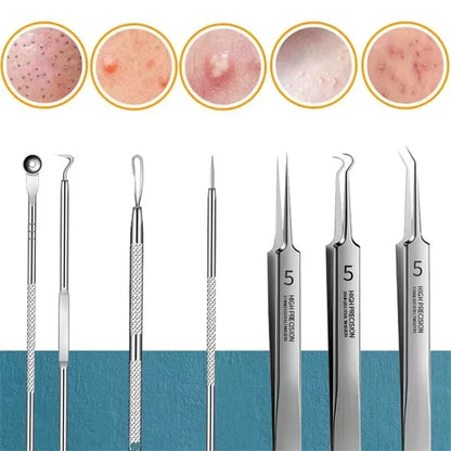 Ultimate Acne & Blackhead Remover Kit - 11 Pcs Ultra-Fine Tweezers & Extractors for Flawless Skin